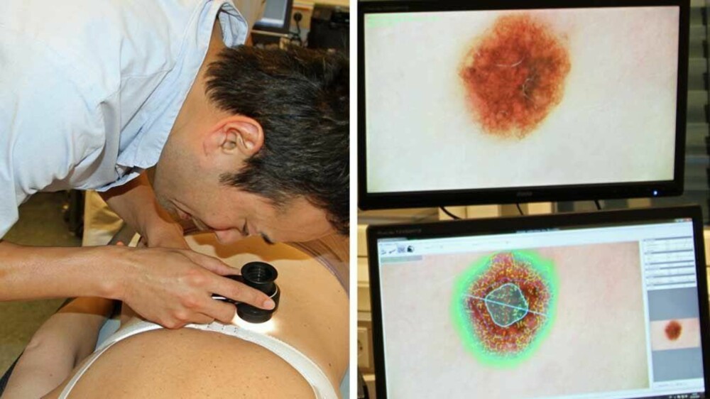 Spesialist i hudsykdommer Xiatong Li ser nøyere på noen føflekker i dermatoskopet. Etterpå blåses noen av føflekkene som er blitt tatt bilde av opp for lettere å se fargenyanser, blant annet. Spesialist i hudsykdommer Xiatong Li ser nøyere på noen føflekker i dermatoskopet. Etterpå blåses noen av føflekkene som er blitt tatt bilde av opp for lettere å se fargenyanser, blant annet.