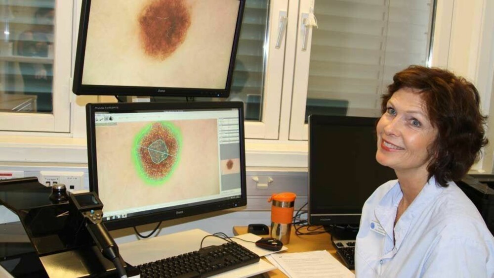 Sykepleier Anette Paus har tatt bilder av hele kroppen og etterpå illustrerer hun hvordan føflekkene kan blåses opp og måles. Sykepleier Anette Paus har tatt bilder av hele kroppen og etterpå illustrerer hun hvordan føflekkene kan blåses opp og måles.