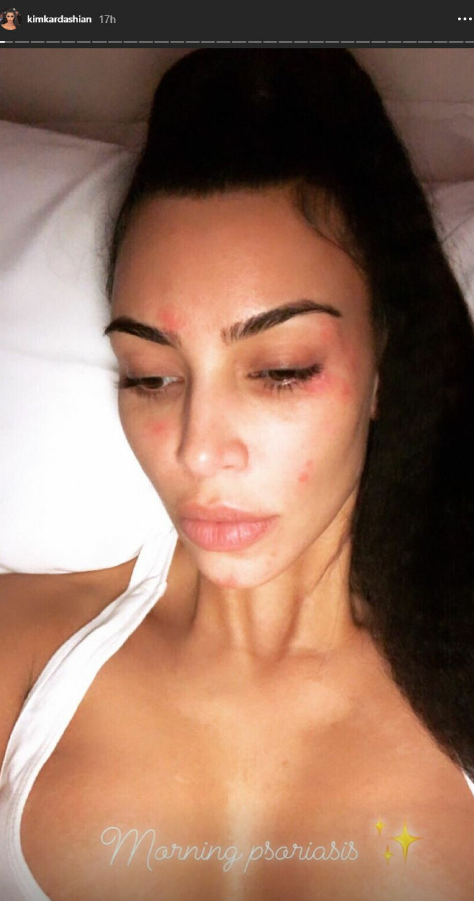 INSTA: Kim Kardashian postet dette nærbildet av huden sin på Instagram story i helgen. INSTA: Kim Kardashian postet dette nærbildet av huden sin på Instagram story i helgen.