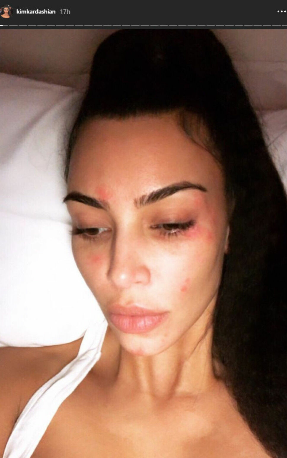 UTEN SMINKE: Kim Kardashian har hudtilstanden psoriasis og viste frem huden sin uten sminke på Instagram stories nylig. UTEN SMINKE: Kim Kardashian har hudtilstanden psoriasis og viste frem huden sin uten sminke på Instagram stories nylig.