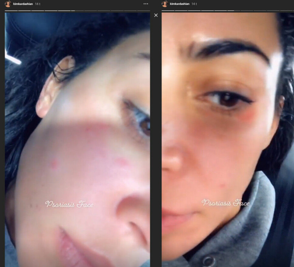 UTEN SMINKE: Kim Kardashian har flere ganger den siste tiden lagt ut bilder av psoriasisen sin i sosiale medier, hvor hun også er sminkefri. UTEN SMINKE: Kim Kardashian har flere ganger den siste tiden lagt ut bilder av psoriasisen sin i sosiale medier, hvor hun også er sminkefri.